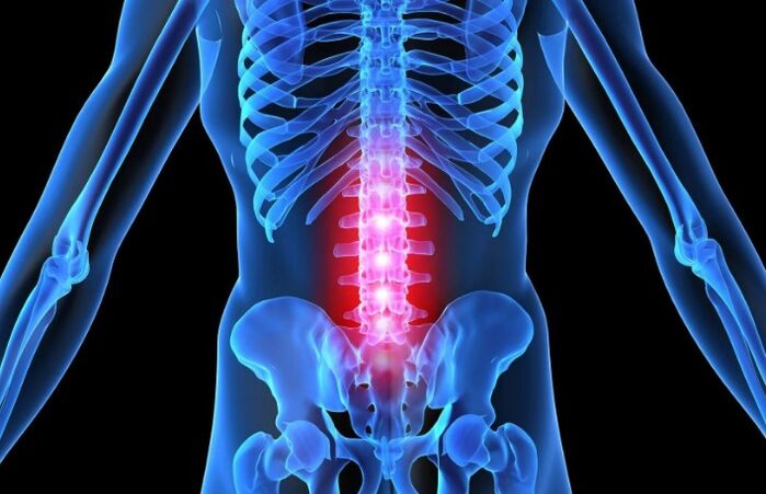 Lumbar eskualdeko osteokondrosia