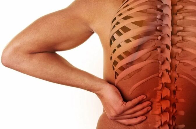 Lumbar osteochondrosia