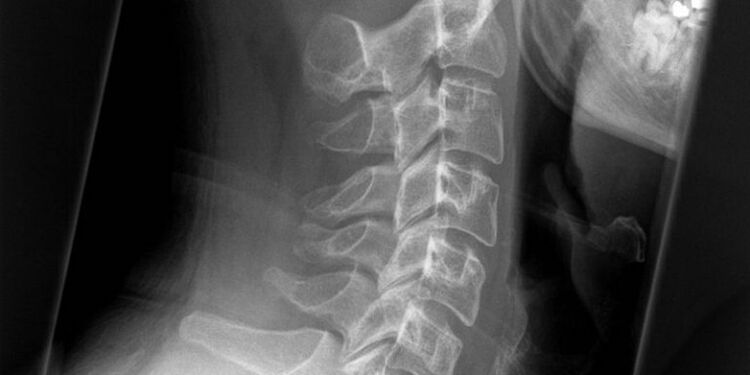 Cervical eskualdearen argazkia