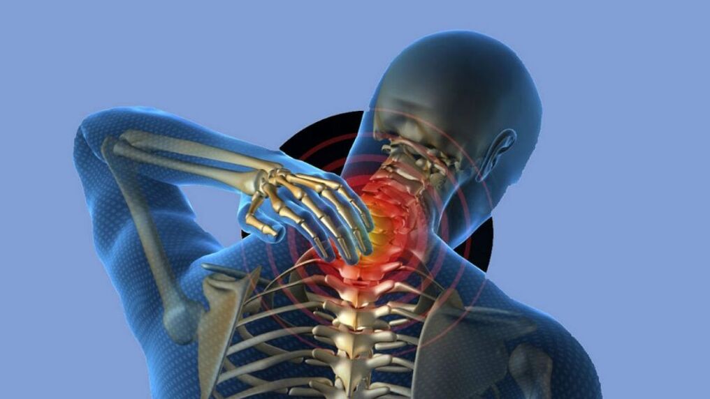 Cervical eskualdeko osteokondrosia